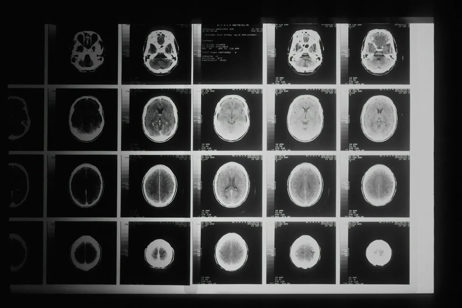 Grid of brain MRI scan images